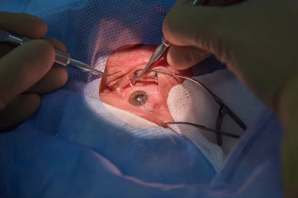 Using Iris retractors during ophtalmology operation. — 스톡 사진