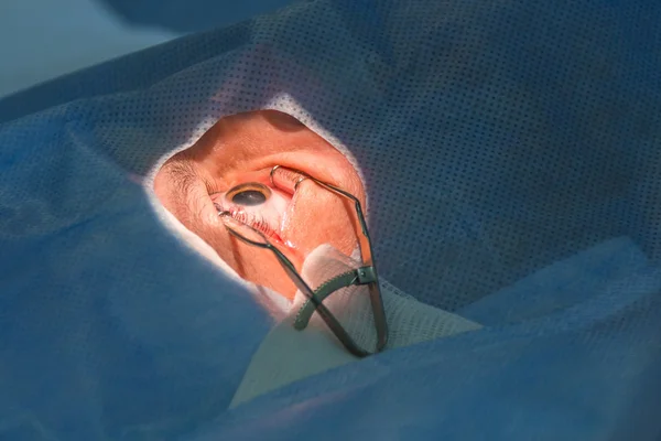 Bimanual cataract extraction — Stok fotoğraf