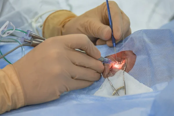 Using Iris retractors during ophtalmology operation. — Stock Fotó