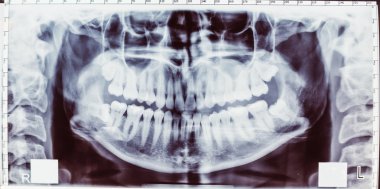 Diş modern Radyografi