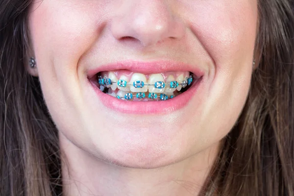 Dental braces — Stock Photo, Image