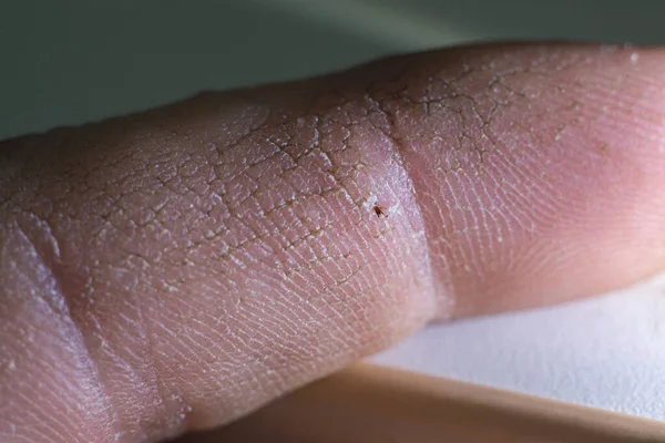 Een Grote Splinter Vinger Van Iemands Hand Rechtenvrije Stockafbeeldingen