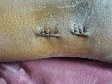 skin cancer surgery stitches closeup of human body at Operation room