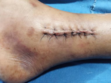 Skin stitches closeup after leg bone surgery of human body