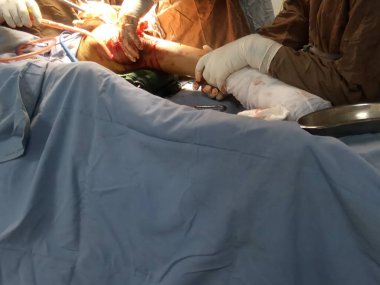Doctors team doing broken leg surgery at critical condition