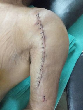 Body skin stitches closeup picture at hospital bed