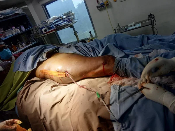 大腿骨骨骨手術後に病院のベッドに横たわっ男性患者 — ストック写真