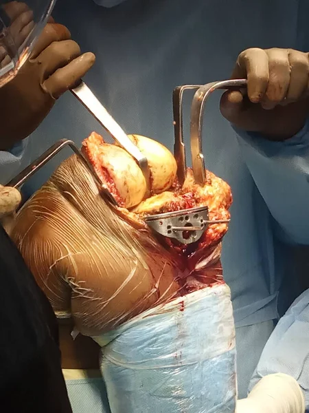 医療器具による手術中に膝の骨をつかむ — ストック写真