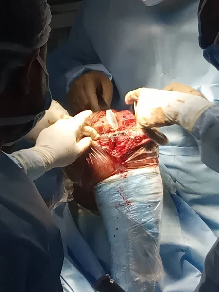 Knee Bone Surgery Critical Closeup Picture Operations — Stok fotoğraf