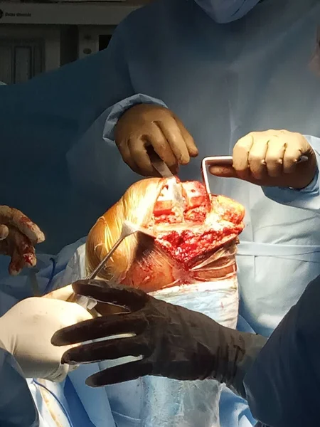 Chirurgiens Hospitaliers Faisant Chirurgie Des Genou Utilisant Des Outils Médicaux — Photo