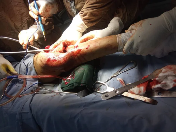 의료진들 다리를 절단하는 수술을 — 스톡 사진