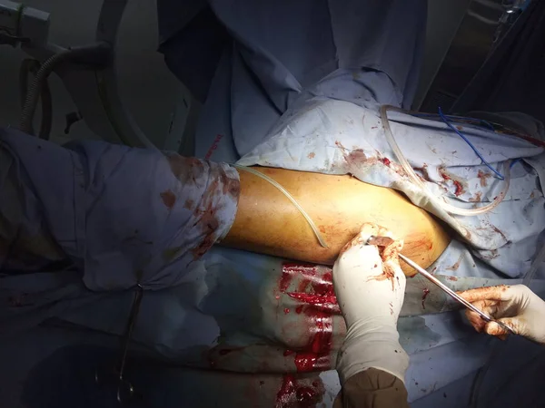 Femur Bone Surgery Performing Asian Surgeons — Stok fotoğraf