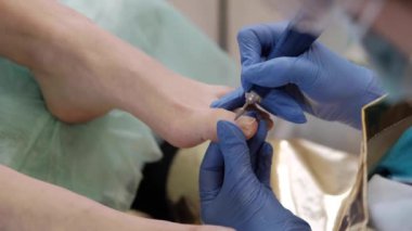 Tırnak törpüsü matkabıyla donanım tıbbi pedikür. Pediyatrist ayak hastalıkları uzmanıyla pedikür tedavisi gören hasta. Özel bir cihazla kaplıcada ayak soyma tedavisi. Podoloji Kliniği.