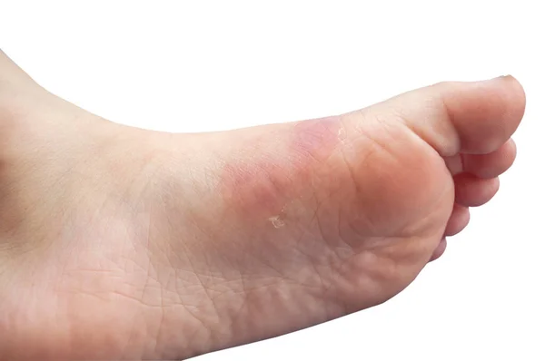 Bir çocuğun ayağında yanık izi, yakın plan fotoğrafı, beyaz bir arkaplanda izole edilmiş.