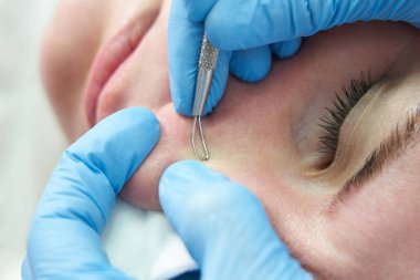 Kadın sivilce aldırmak için sivilce aldırma çubuğu kullanıyor. Sivilceli, yağlı suratını sıkarak.