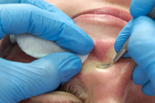 Mujer utiliza palillo de eliminación de acné para eliminar las espinillas de la cabeza blanca en la cara apretando en granos golpe, grasa grasa cara — Foto de Stock