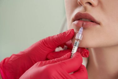 Dudak büyütme görüntüsünü kapat. Dudaklar için Güzellik Enjeksiyonu Alınan Kadın