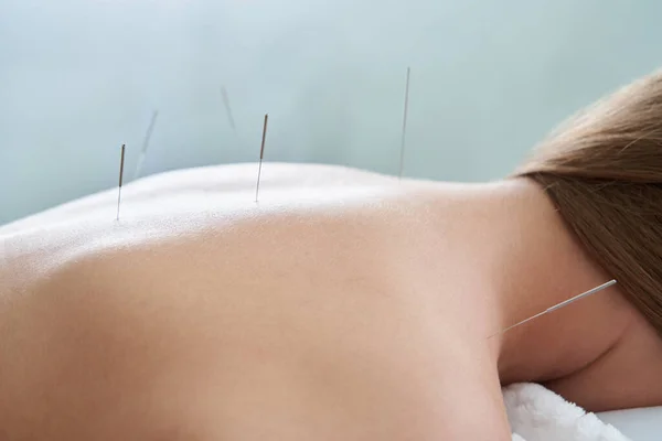 Costas femininas com agulhas na terapia de tratamento de acupuntura no salão de spa. Conceito de Medicina Alternativa — Fotografia de Stock