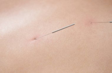 Spa salonundaki akupunktur tedavisi için iğneli bir kadın. Alternatif Tıp Konsepti