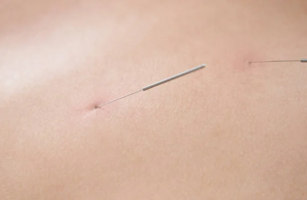 Espalda femenina con agujas en la terapia de tratamiento de acupuntura en el salón de spa. Concepto de medicina alternativa — Foto de Stock
