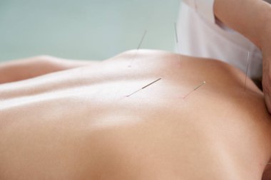 Doktor, kaplıca salonundaki akupunktur tedavisi için kadınlara iğne batırıyor. Alternatif Tıp Konsepti