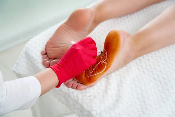 Lekarz przygotowujący się do wstrzyknięć toksyny botulinowej w żeńskie stopy przed nadmierną potliwością, nadmierną potliwością — Zdjęcie stockowe