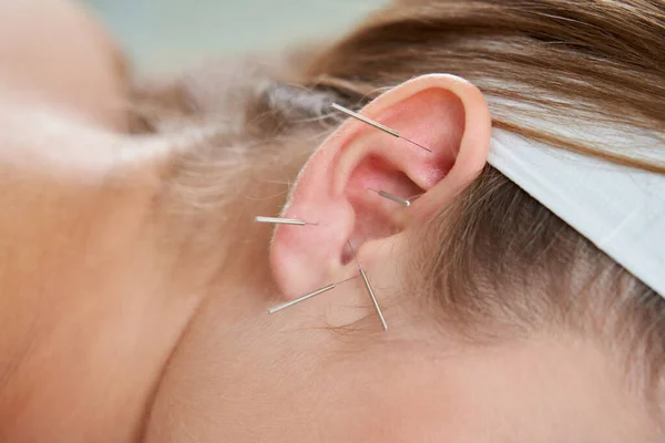 Beautiful woman relaxing on a bed having acupuncture treatment with needles in and around her ear. Alternative Therapy concept — Stock Photo, Image