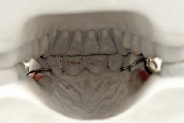 Dental gjuta isolerad — Stockfoto