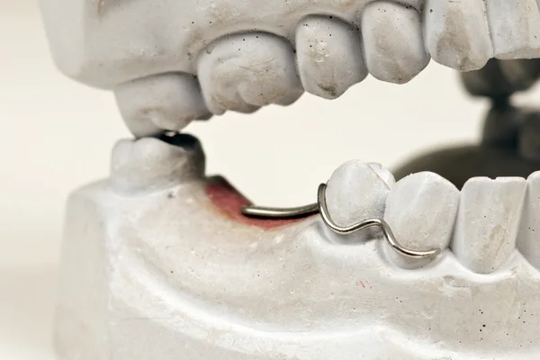 Molde dental aislado — Foto de Stock