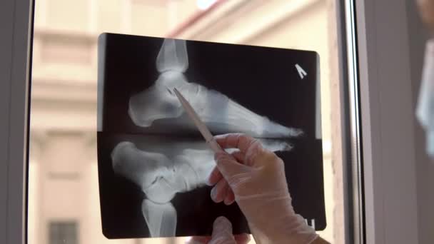 Le médecin examine le film radiographique du pied cassé — Video