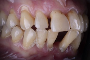 İnsan dişi, diş ağrısı tedavi edilmeli..