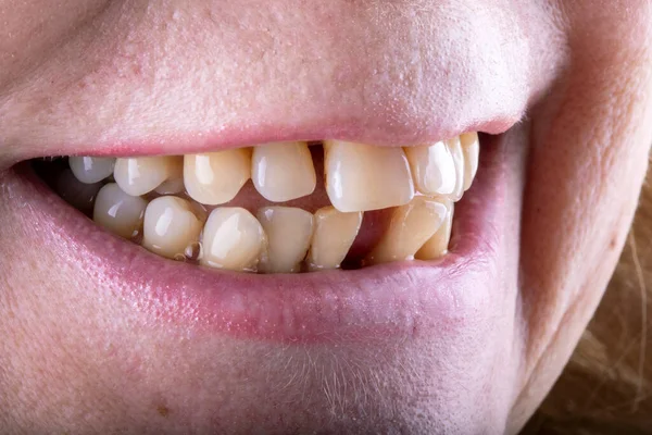 Lidské Zuby Bolesti Zubů Třeba Léčit — Stock fotografie