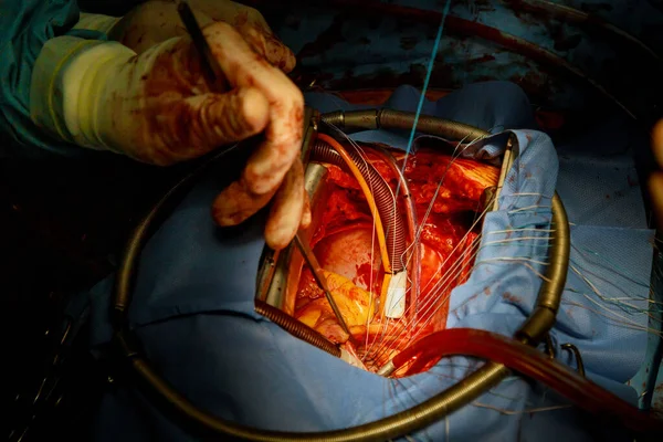 Paziente Durante Intervento Cardiochirurgia Ospedale Nella Sala Operatoria Chirurgica — Foto Stock