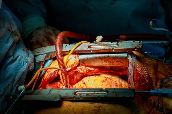 Diversi Strumenti Chirurgici Tubi Collegati Cuore Close Chirurgia Cuore Aperto — Foto Stock