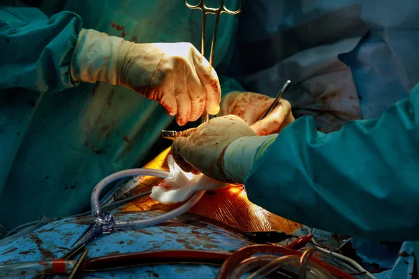 手術室で開かれた心臓外科の外科医のチーム — ストック写真