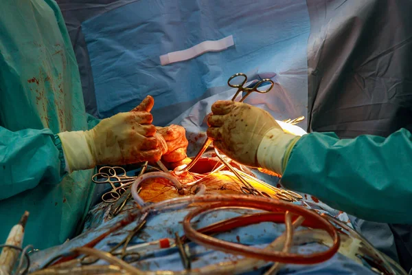 Beating human heart in opened chest during the surgery chest during heart surgery