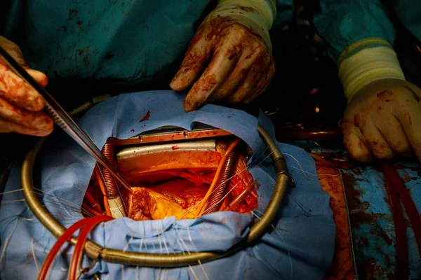 外科医生的手在开胸手术中操作 — 图库照片