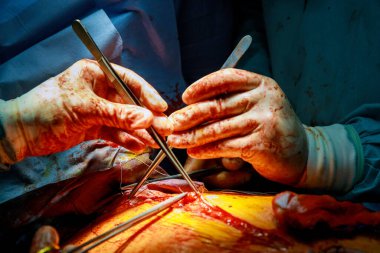 Cerrahın elleri hastanede geçirdiği bir ameliyattan sonra bir yarayı dikiyor.