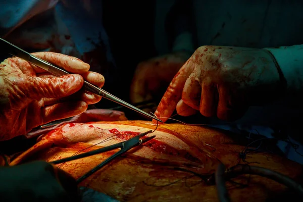 Los Médicos Cierran Pecho Después Cirugía Con Sutura Piel —  Fotos de Stock