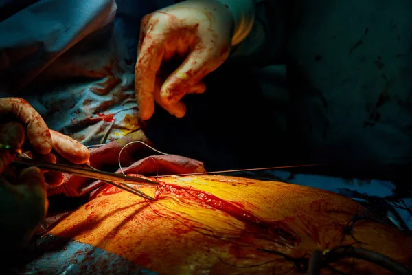 Svetsade Ihop Huden Efter Operation Sjuk Patient Efter Allvarlig Operation — Stockfoto