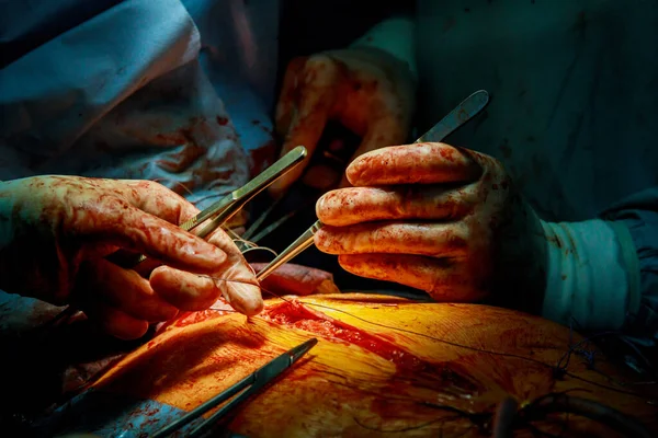 外科医の手が傷を縫ってる病院で手術した後 — ストック写真