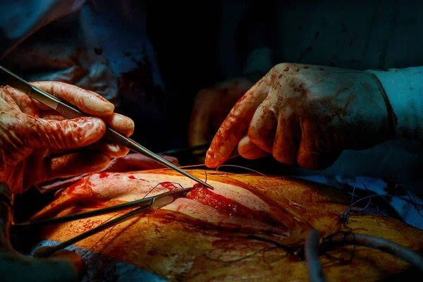 Surgeons Suturing Sick Patient Operation Performing Serious Surgery — Stock Photo, Image