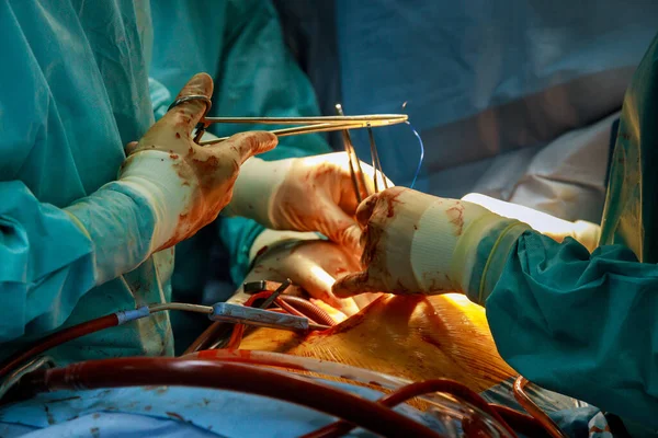 Mãos Cirurgião Estão Operando Durante Cirurgia Com Procedimento Coração Aberto — Fotografia de Stock