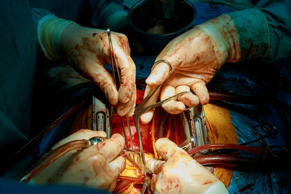 I medici eseguono la rimozione della valvola cardiaca danneggiata è prima dell'operazione di sostituzione a cuore aperto — Foto Stock