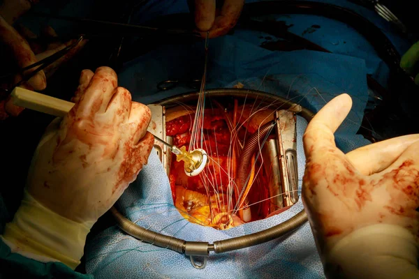 Procedimiento a corazón abierto, cirugía valvular aórtica — Foto de Stock