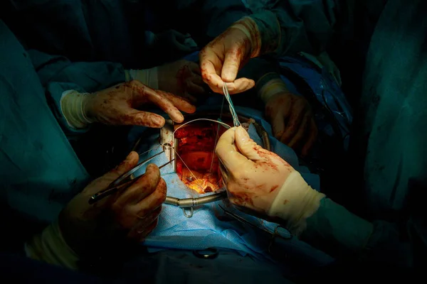 Surgeon is tying knots on the heart on mechanical heart valve implantation.