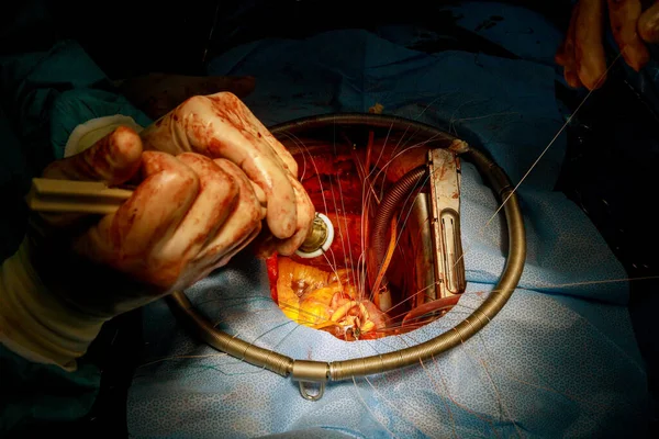 Sebész Varratokat Helyez Bioprotézisre Mesterséges Szívbillentyű Implantáció Nyitott Szívbe — Stock Fotó