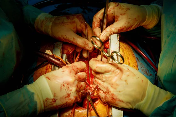 Paciente Durante Uma Cirurgia Cardíaca Hospital Sala Cirurgia Cirúrgica — Fotografia de Stock