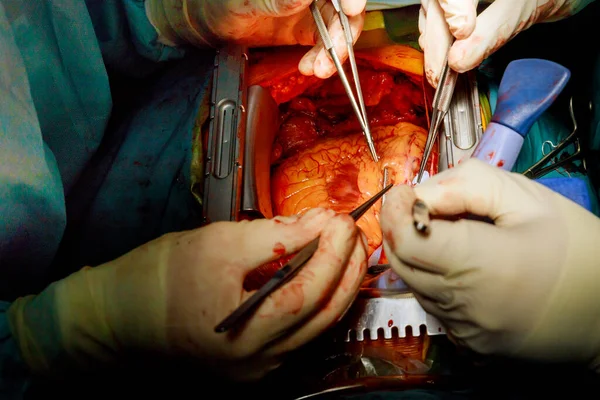 Equipo Cirujanos Injerto Bypass Arteria Coronaria Hospitalaria Para Cirugía Corazón — Foto de Stock