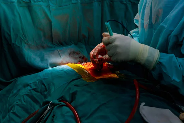 Cirugia Pulmonar Cirujano Equipo Realizan Cirugía Torácica Cáncer Pulmón — Foto de Stock